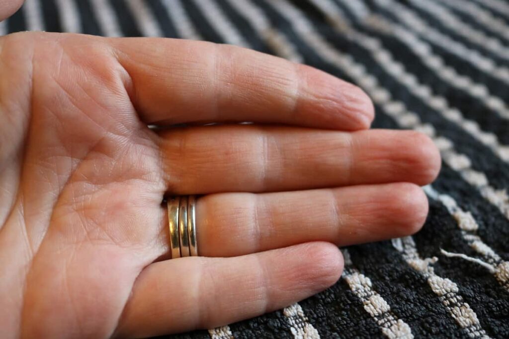 closeup of hand after using mustard for burn