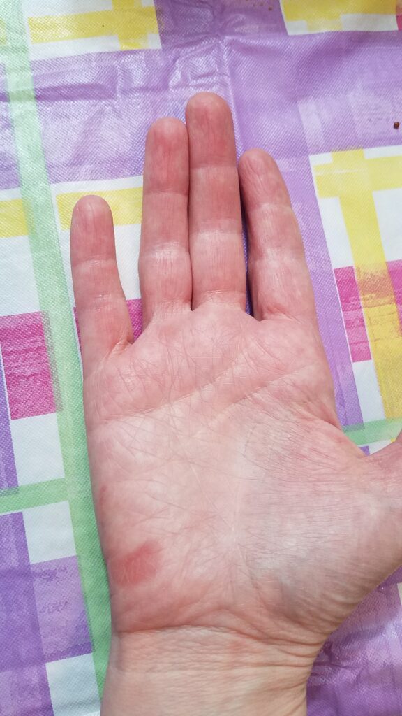 My hand much better after burn-- it never blistered