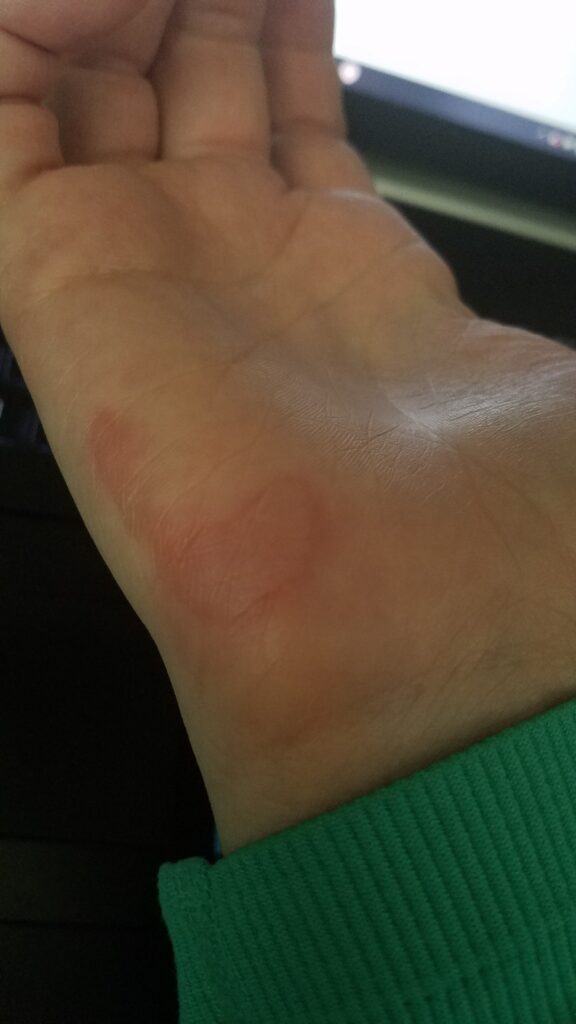 less than 24 hours after I badly burned my hand, showing the redness