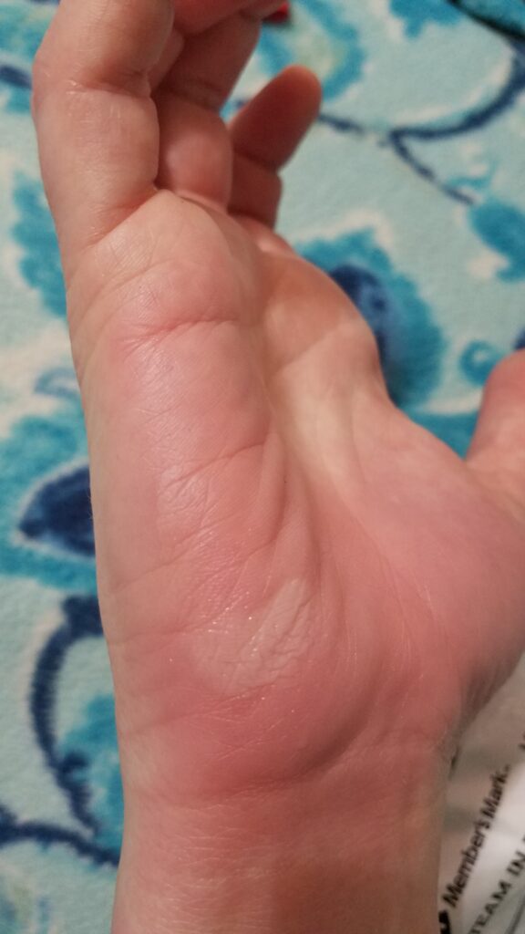 my burned hand