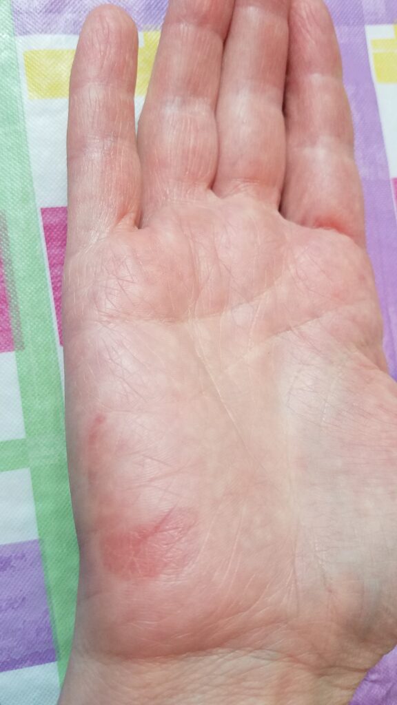 the 4th day after my hand was badly burned