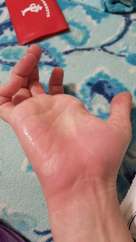 another angle of my burned hand
