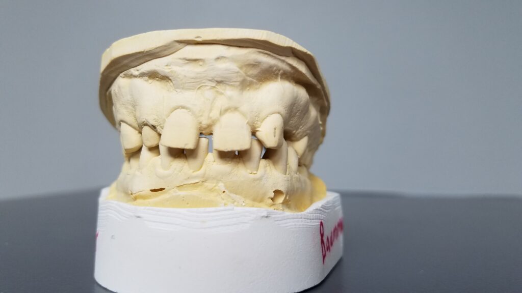 my model of my teeth